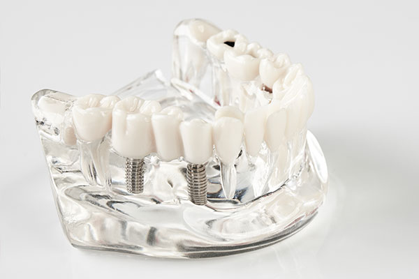 Benefits of All-On-X Dental Implants