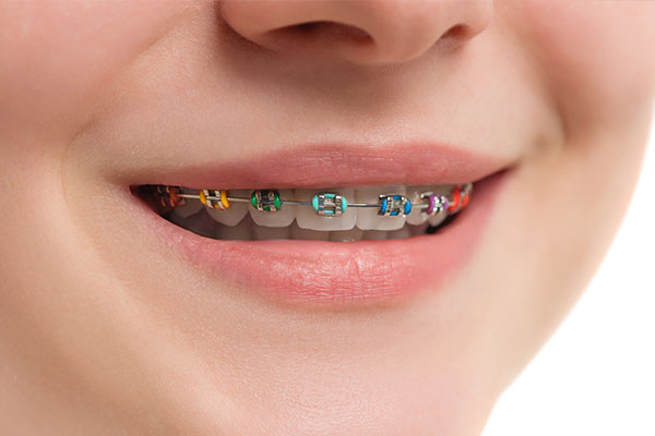 What Foods Should I Avoid During Braces Treatment?