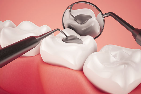 What Are Dental Fillings?