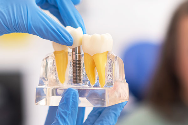 Dental Implants Orlando