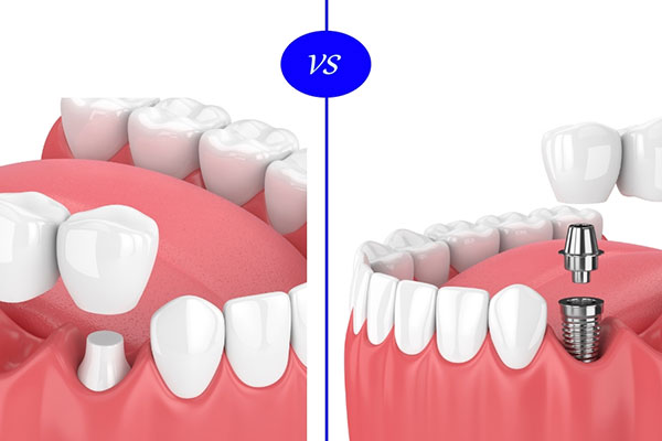 Dental Implants Orlando