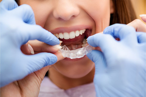 How Long Does Invisalign Treatment Take?